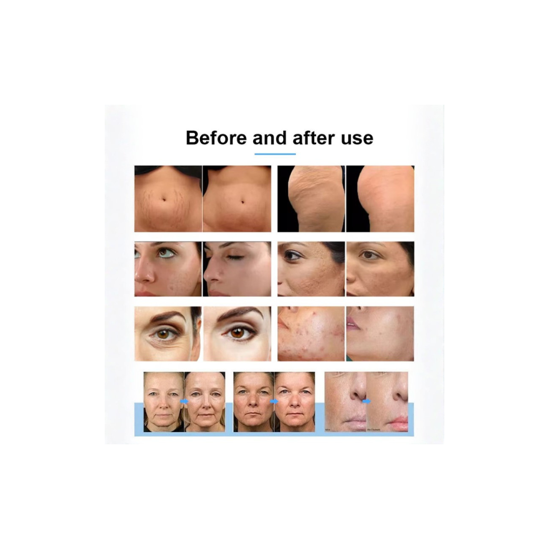 DermaLuxe Gold RF Microneedling Machine