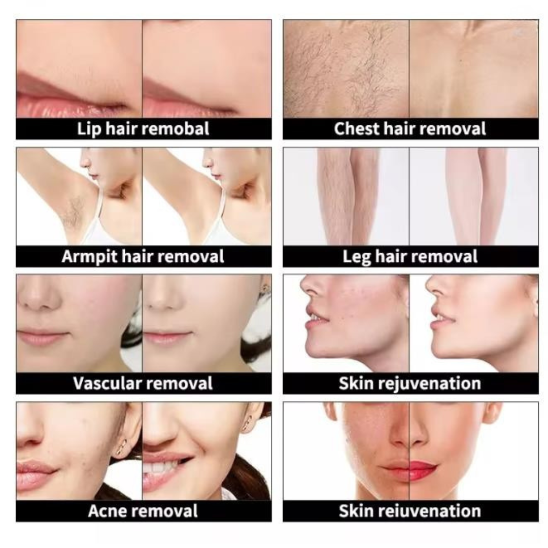 Pro IPL Hair Removal & Skin Renewal System – PuraSkin