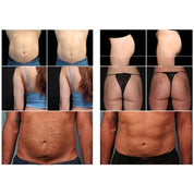 Cryolipolysis + EMS Machine for Body Sculpting 2 in 1