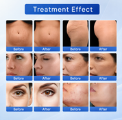 Metaphor 8 Microneedling RF Machine 3 In 1