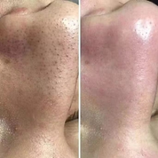 17 In 1 Hydra Skin Care System Facial Machine Elite